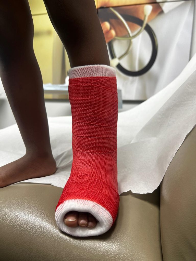 Ankle fractures treated immediately